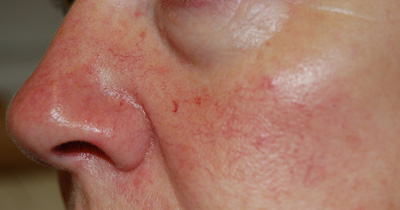 Facial Thread Veins Before Treatment